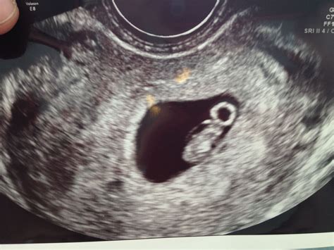 Concern I went in for an ultrasound today and the doc said my gestational sac was measuring 8 weeks, but the baby was only measuring 6 weeks2 days. . Baby measuring a week behind at 7 weeks no heartbeat